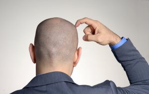 Rear view from a bald head man,thinking and touching his head